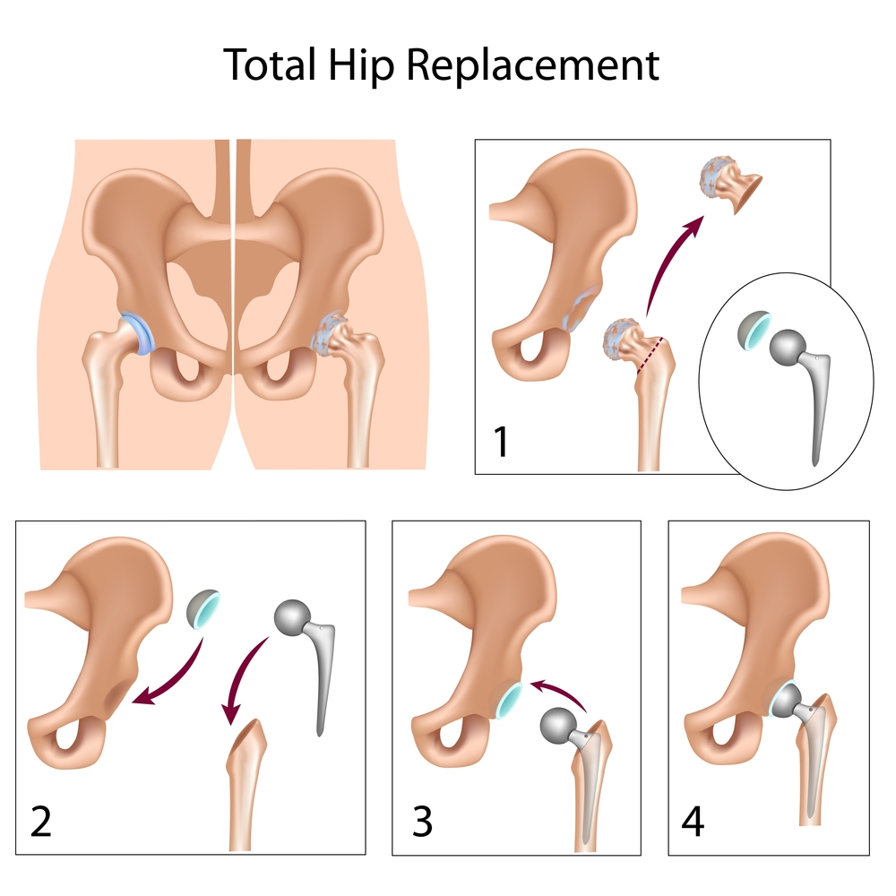 Zimmer Durom Cup Artificial Hip Replacement Injuryboard Com