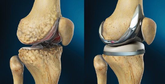 complete knee replacement