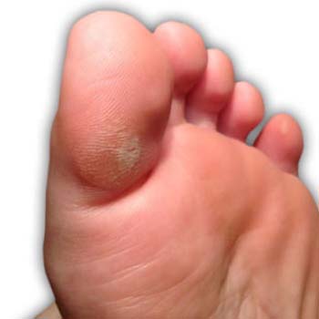 toe cones